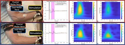 Peripheral Nerve Magnetoneurography With Optically Pumped Magnetometers